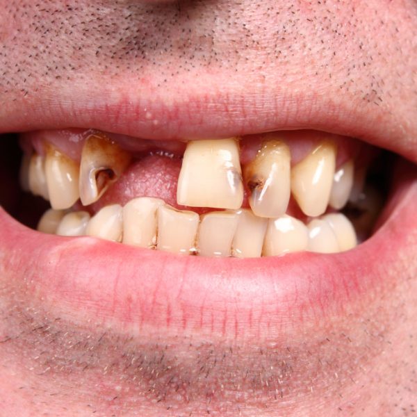 missing tooth with cavities